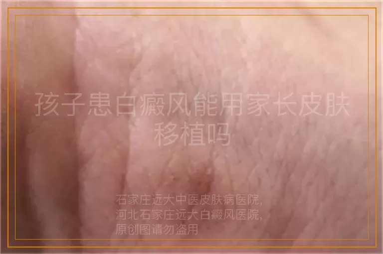 孩子患白癜风能用家长皮肤移植吗