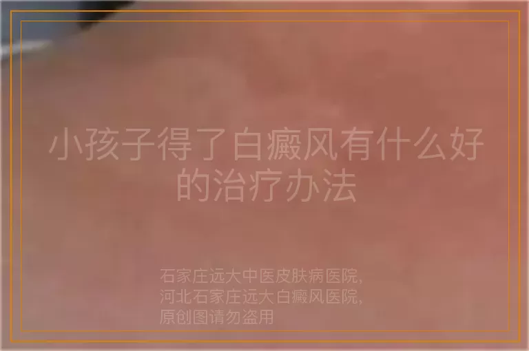 小孩子得了白癜风有什么好的治疗办法