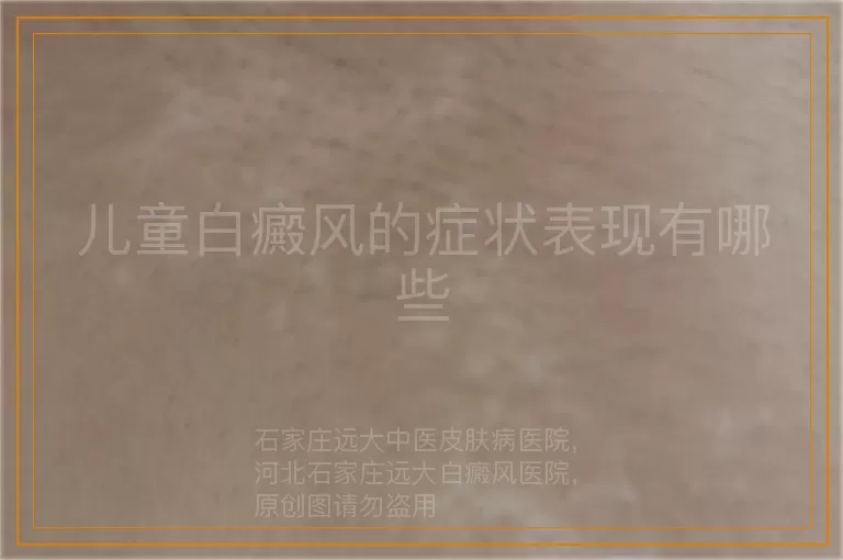 儿童白癜风的症状表现有哪些