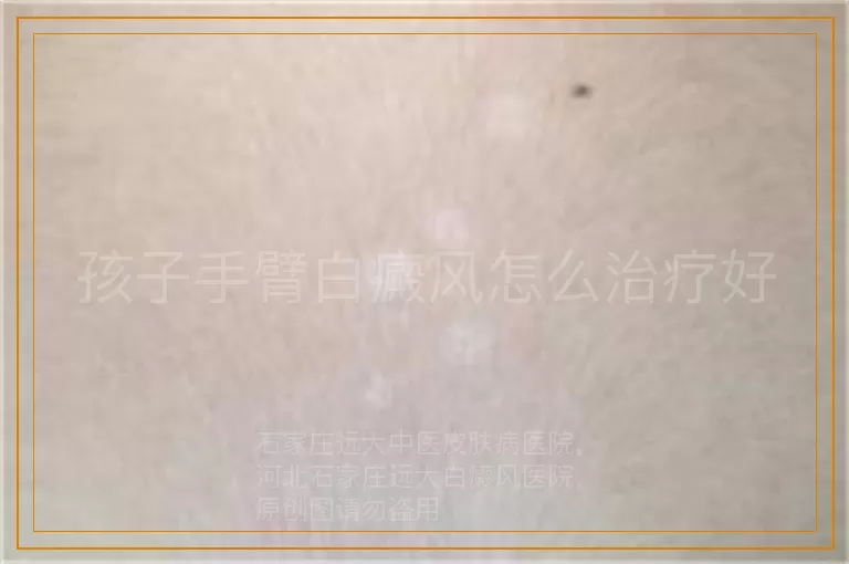 孩子手臂白癜风怎么治疗好