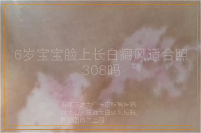 6岁宝宝脸上长白癜风适合照308吗