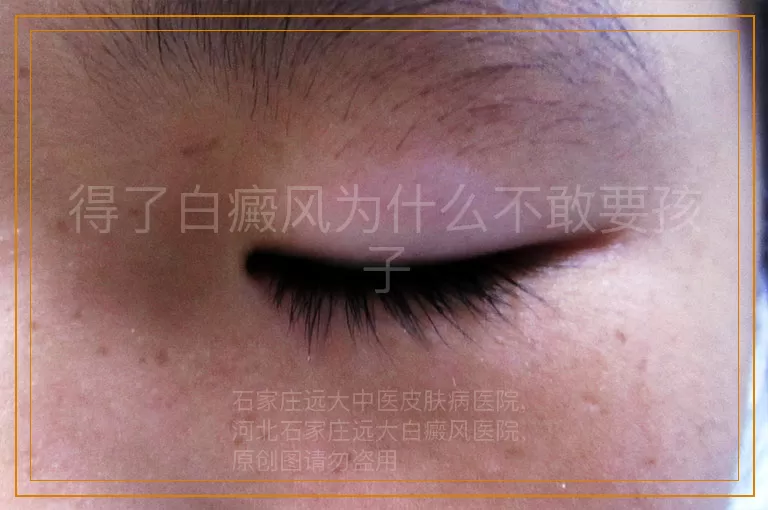得了白癜风为什么不敢要孩子