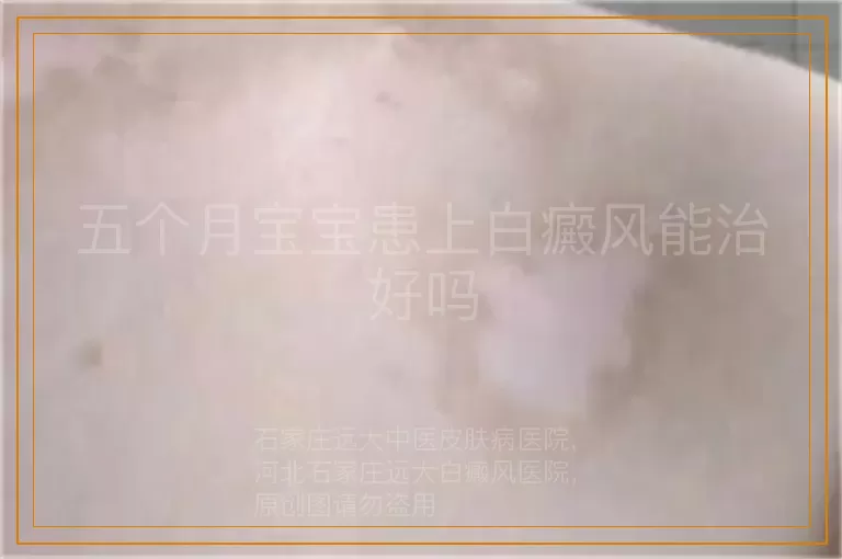 五个月宝宝患上白癜风能治好吗
