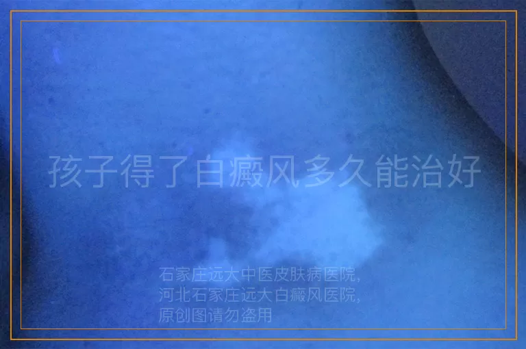 孩子得了白癜风多久能治好