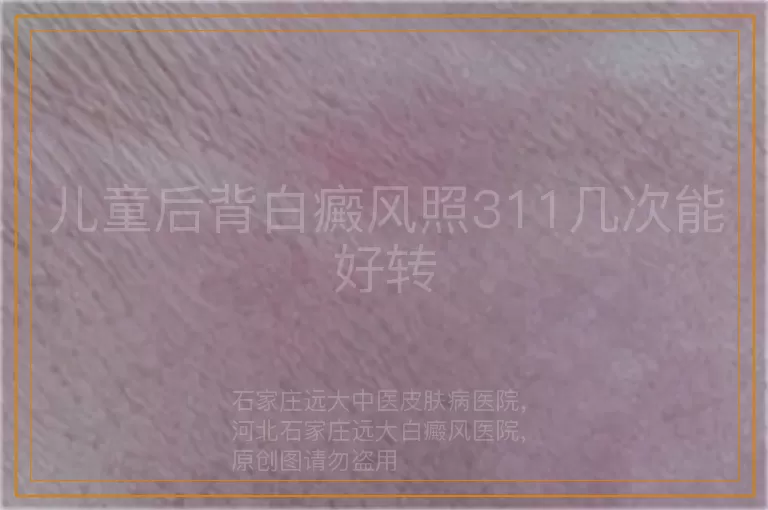 儿童后背白癜风照311几次能好转
