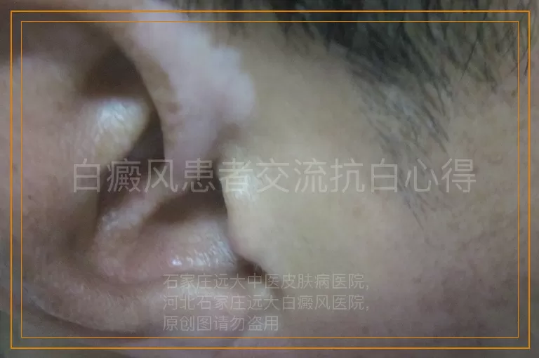 白癜风患者交流抗白心得