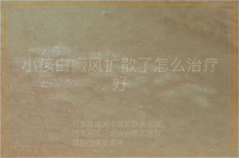 小孩白癜风扩散了怎么治疗好