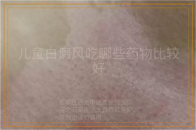 儿童白癜风吃哪些药物比较好