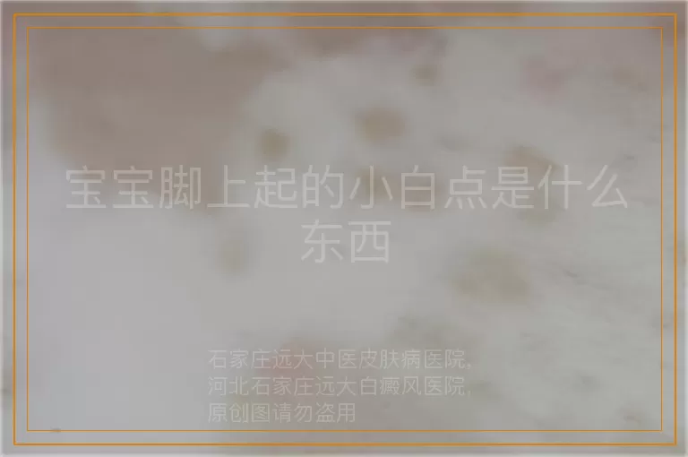 宝宝脚上起的小白点是什么东西