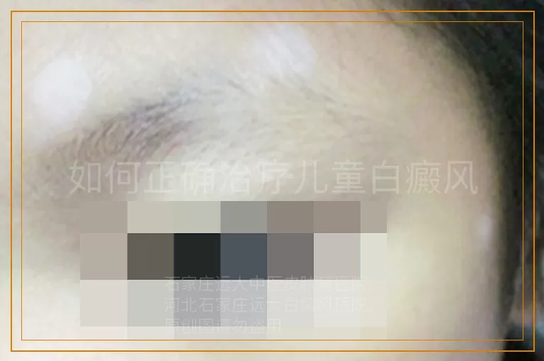 如何正确治疗儿童白癜风