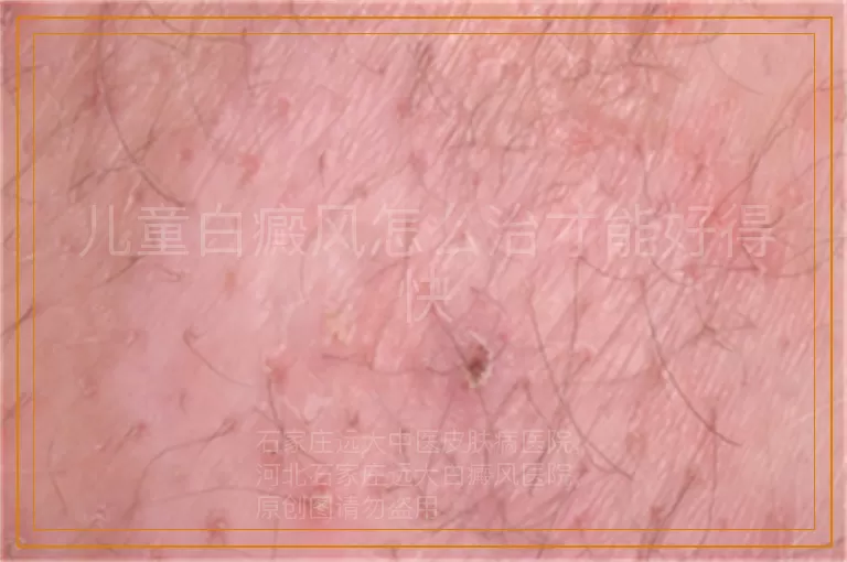 儿童白癜风怎么治才能好得快