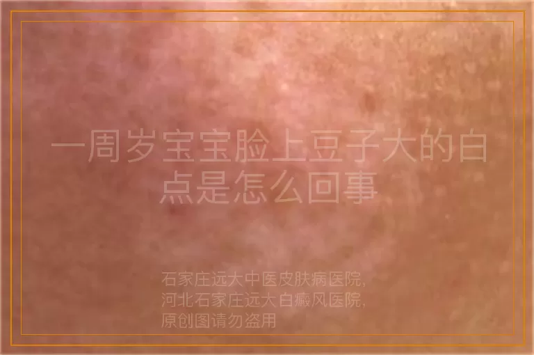 一周岁宝宝脸上豆子大的白点是怎么回事