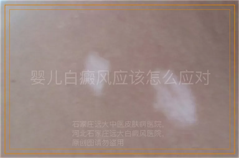 婴儿白癜风应该怎么应对