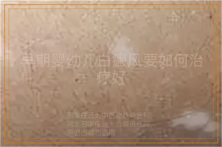 早期婴幼儿白癜风要如何治疗好