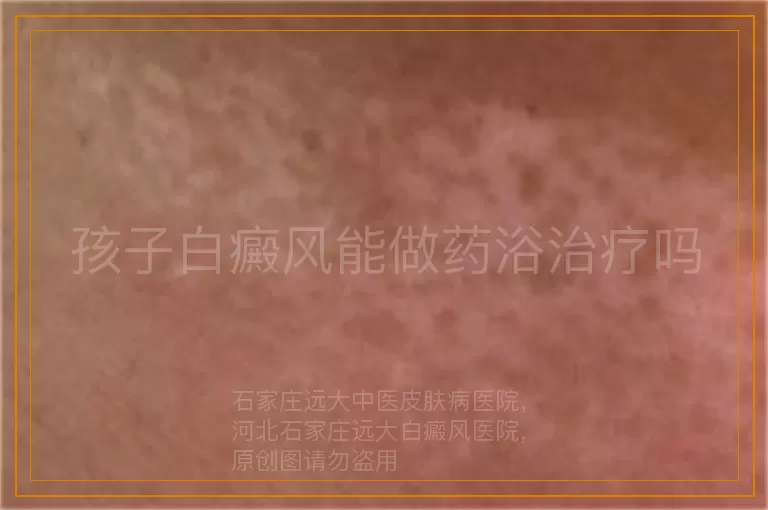 孩子白癜风能做药浴治疗吗