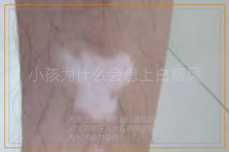 小孩为什么会患上白癜风