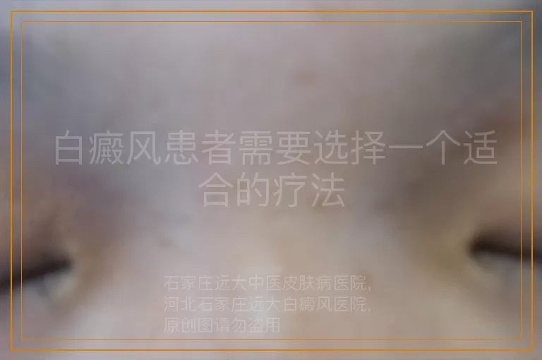 白癜风患者需要选择一个适合的疗法