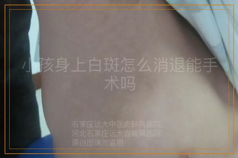 小孩身上白斑怎么消退能手术吗