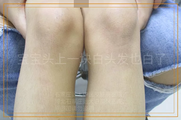 宝宝头上一块白头发也白了