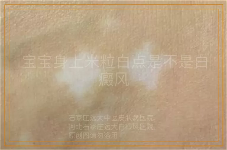 宝宝身上米粒白点是不是白癜风