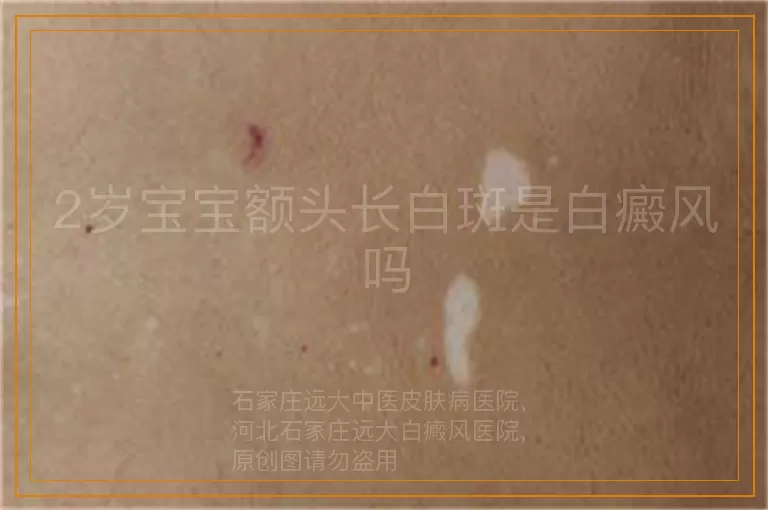 2岁宝宝额头长白斑是白癜风吗