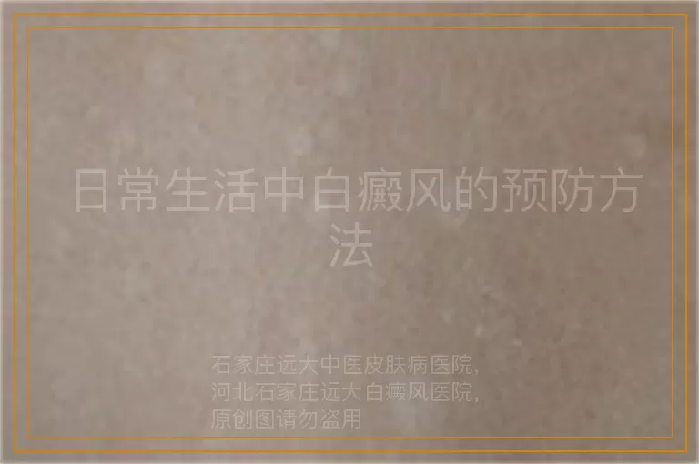 日常生活中白癜风的预防方法