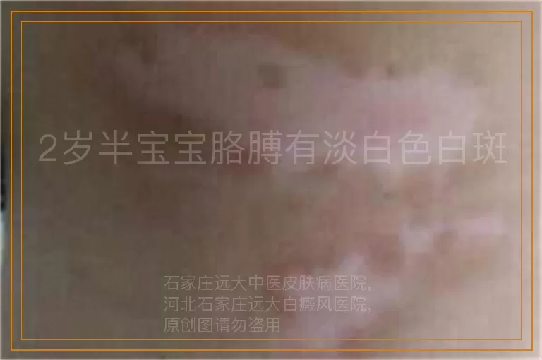 2岁半宝宝胳膊有淡白色白斑