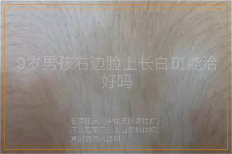 9岁男孩右边脸上长白斑能治好吗