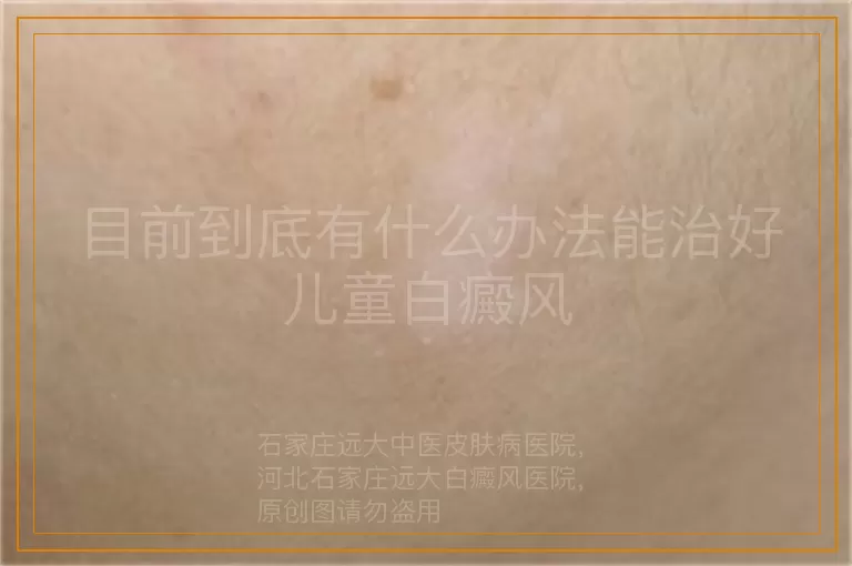 目前到底有什么办法能治好儿童白癜风