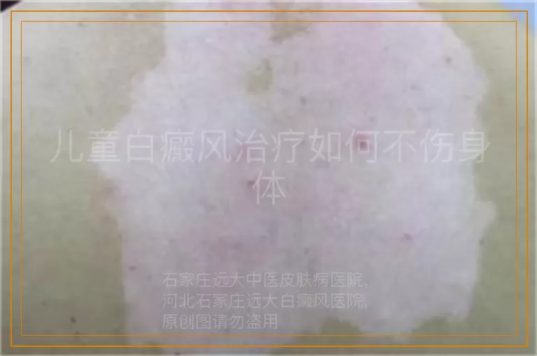 儿童白癜风治疗如何不伤身体