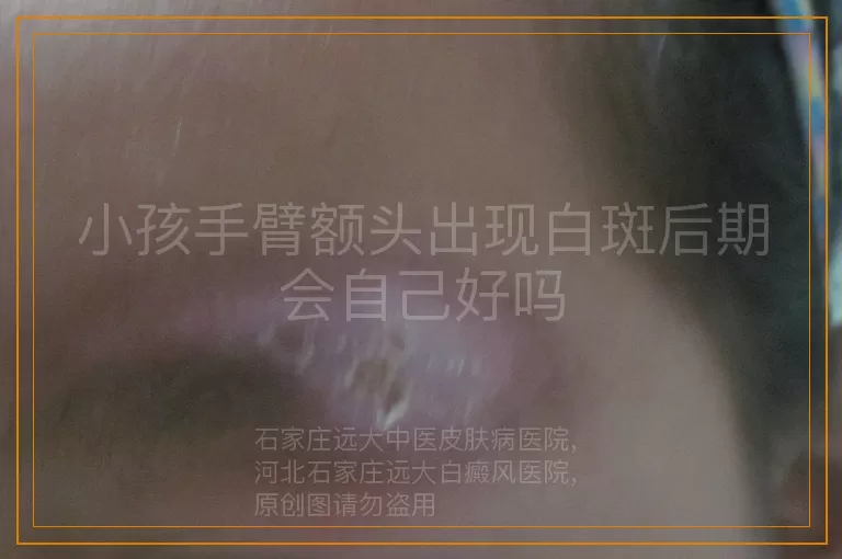 小孩手臂额头出现白斑后期会自己好吗