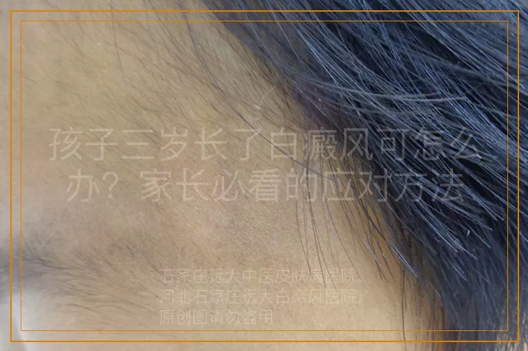 孩子三岁长了白癜风可怎么办？家长必看的应对方法