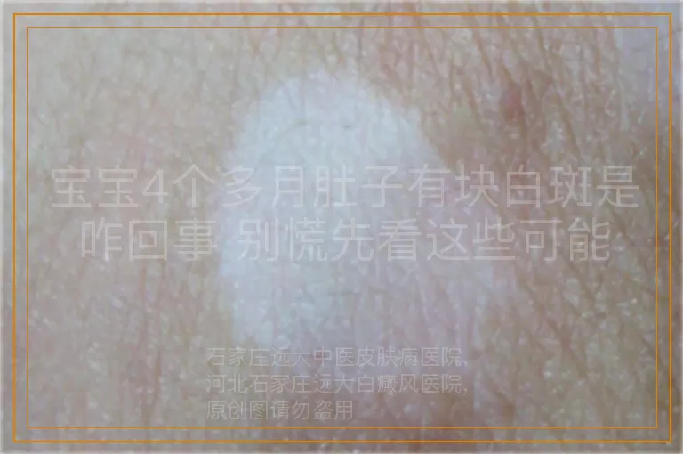 宝宝4个多月肚子有块白斑是咋回事 别慌先看这些可能
