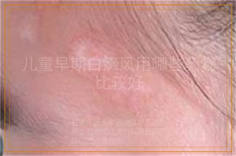 儿童早期白癜风用哪些药物比较好