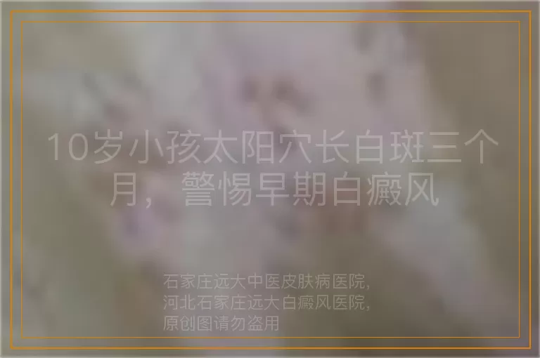 10岁小孩太阳穴长白斑三个月，警惕早期白癜风