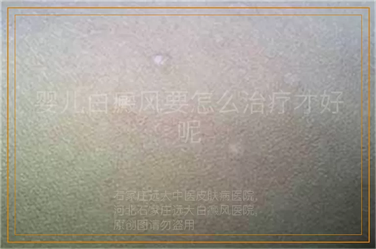 婴儿白癜风要怎么治疗才好呢
