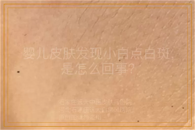 婴儿皮肤发现小白点白斑，是怎么回事？