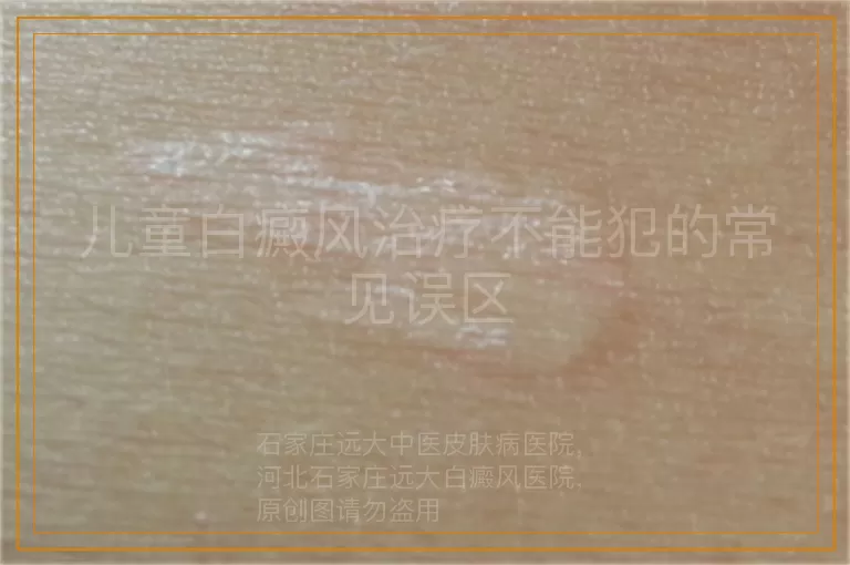 儿童白癜风治疗不能犯的常见误区