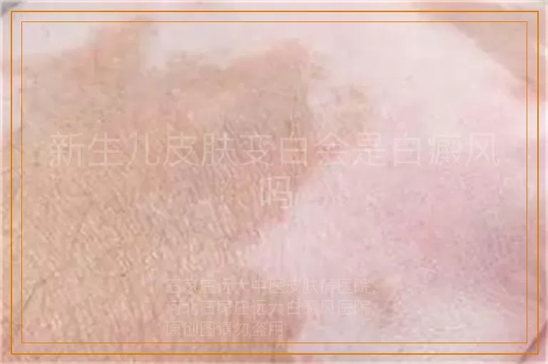 新生儿皮肤变白会是白癜风吗