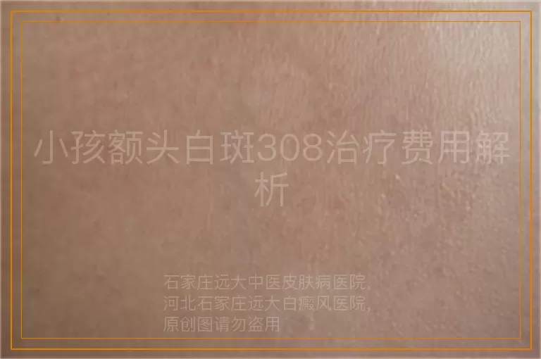 小孩额头白斑308治疗费用解析