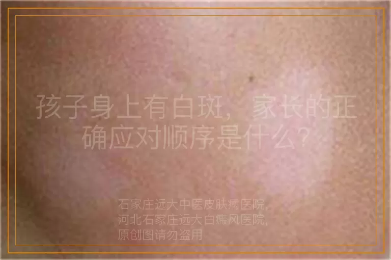 孩子身上有白斑，家长的正确应对顺序是什么？