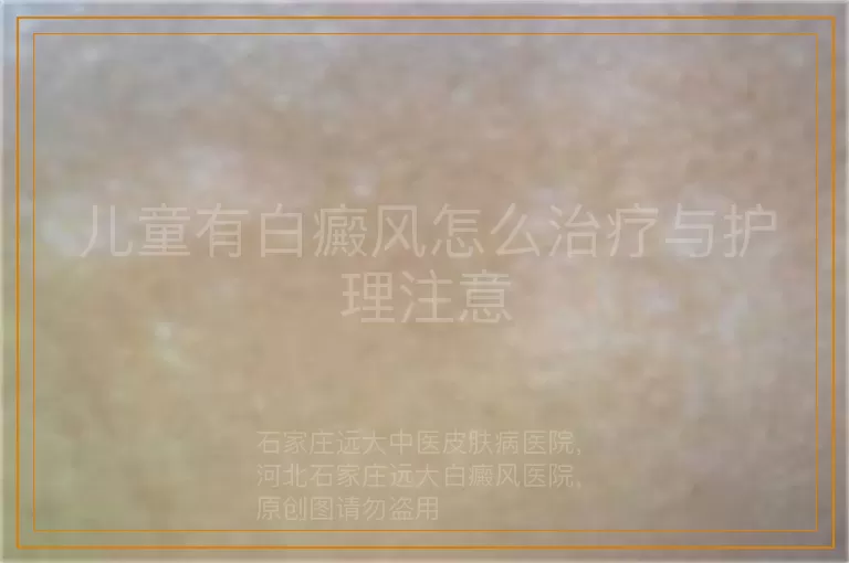 儿童有白癜风怎么治疗与护理注意