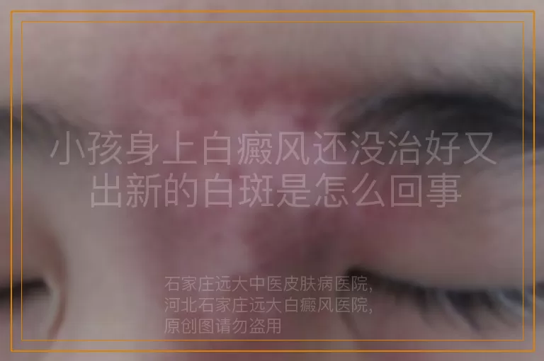 小孩身上白癜风还没治好又出新的白斑是怎么回事