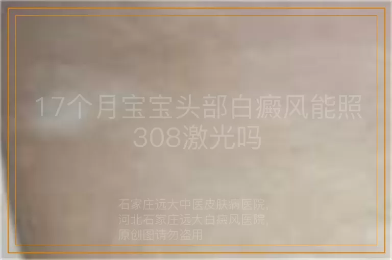 17个月宝宝头部白癜风能照308激光吗