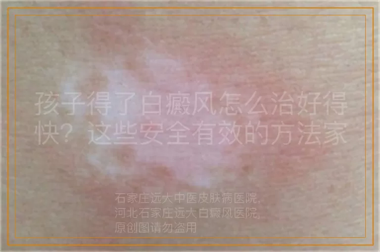 孩子得了白癜风怎么治好得快？这些安全有效的方法家长须知