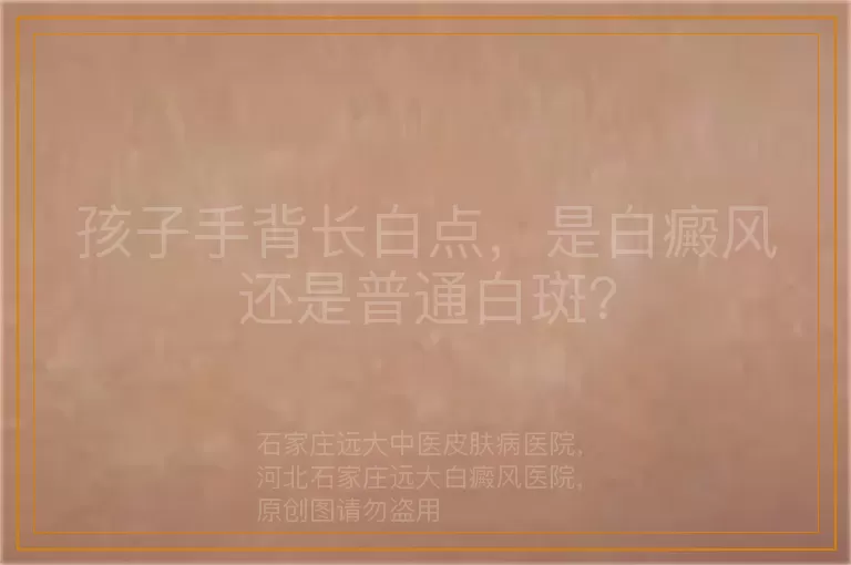 孩子手背长白点，是白癜风还是普通白斑？