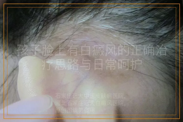 孩子脸上有白癜风的正确治疗思路与日常呵护