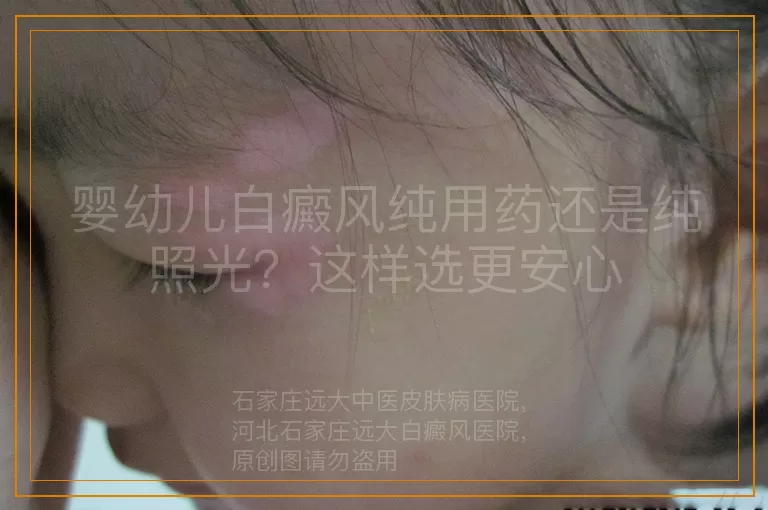 婴幼儿白癜风纯用药还是纯照光？这样选更安心