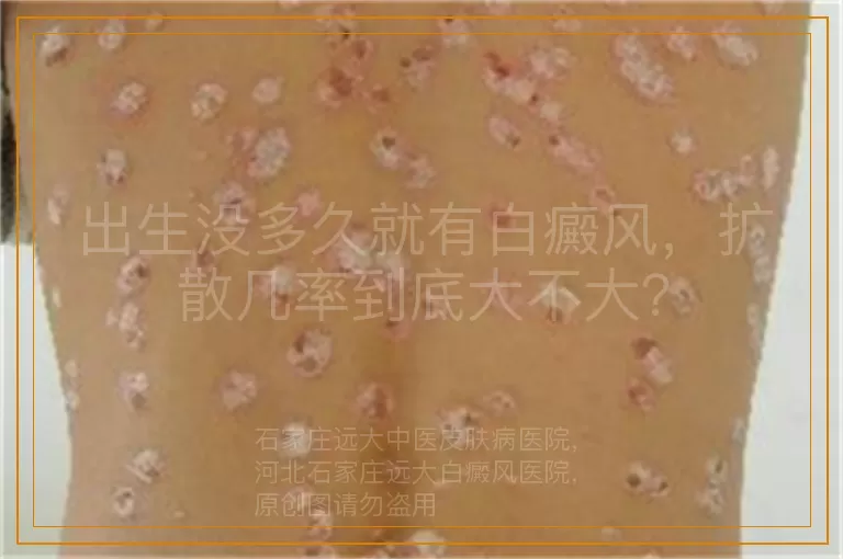 出生没多久就有白癜风，扩散几率到底大不大？