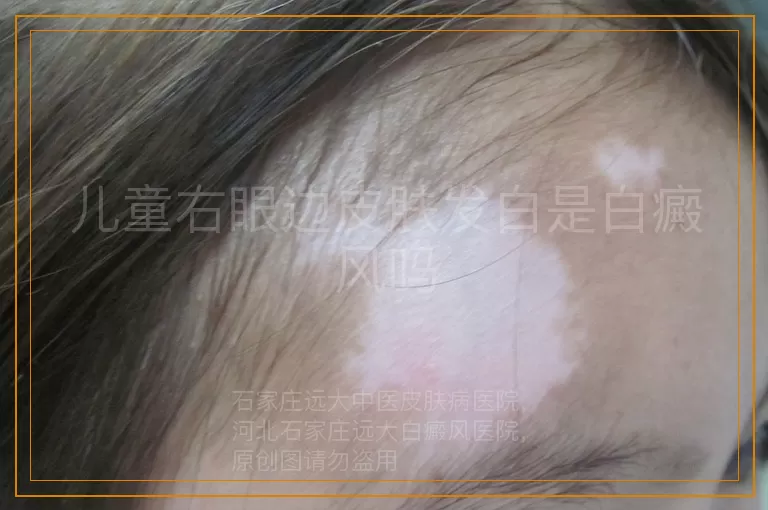 儿童右眼边皮肤发白是白癜风吗